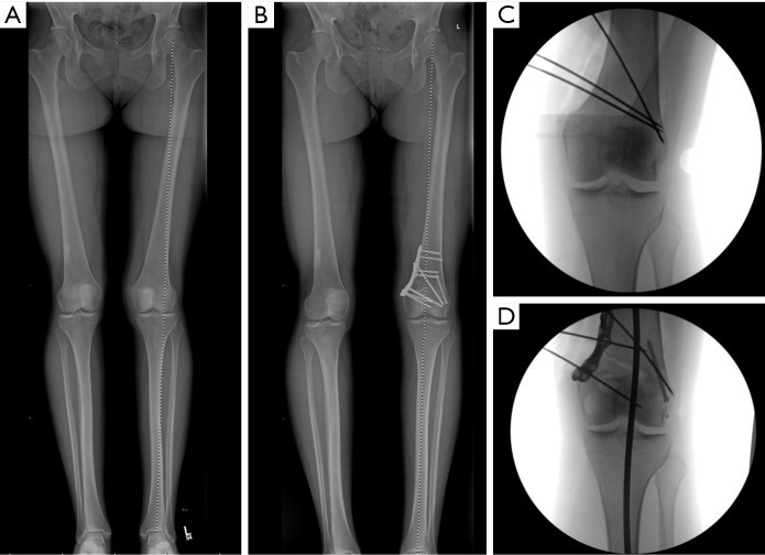 Joint preservation procedures: osteotomies about the knee.