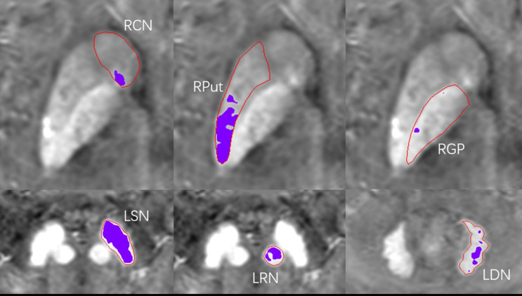 Regional high iron deposition on brain quantitative susceptibility mapping correlates with cognitive decline in chronic kidney disease patients.