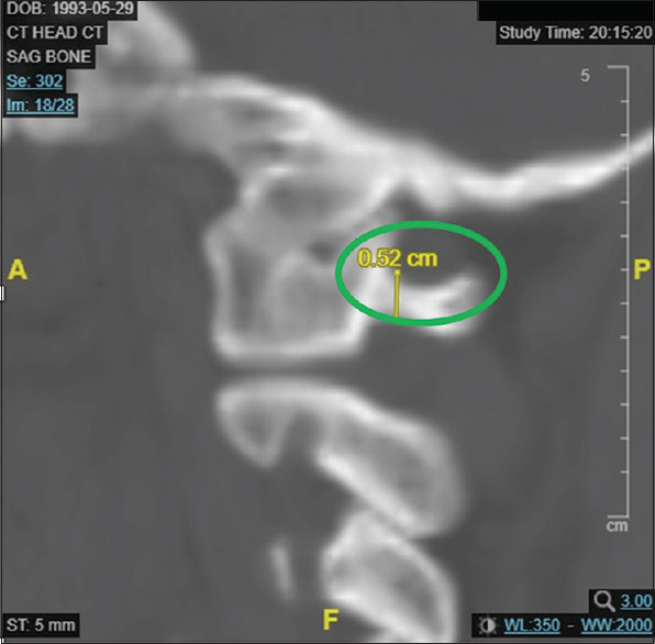 Exploring the prevalence and impact on craniocervical spine surgery of ponticulus posticus on atlas lamina thickness.
