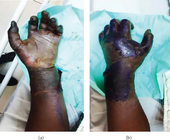 When Time Is Not on Your Side: Delayed Recognition of Hand Compartment Syndrome After a Fracture.