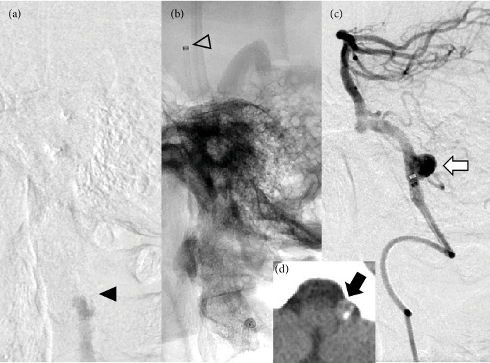 Mechanical Thrombectomy for Large Vessel Occlusion Strokes Involving a Cerebral Aneurysm in the Target Vessel: Case Series.