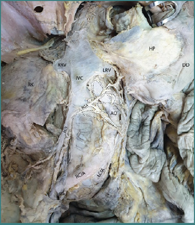 The dissection-based identification of the preaortic sympathetic plexus formation, anatomical relations, and clinical applications.
