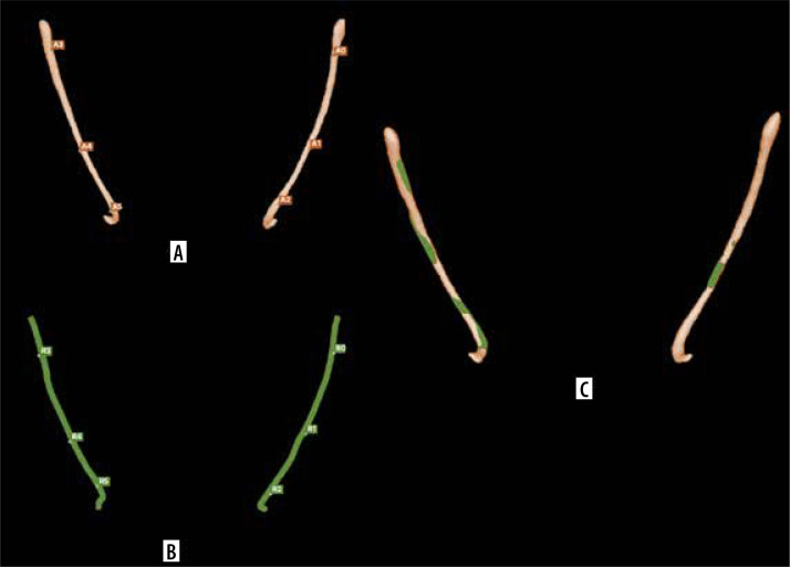 Assessing the accuracy of artificial intelligence in mandibular canal segmentation compared to semi-automatic segmentation on cone-beam computed tomography images.