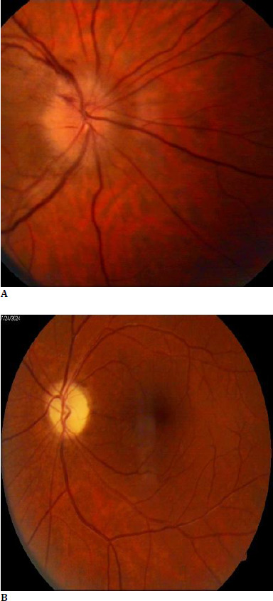 Pseudo Foster-Kennedy Syndrome in an amblyopic patient: a case report.