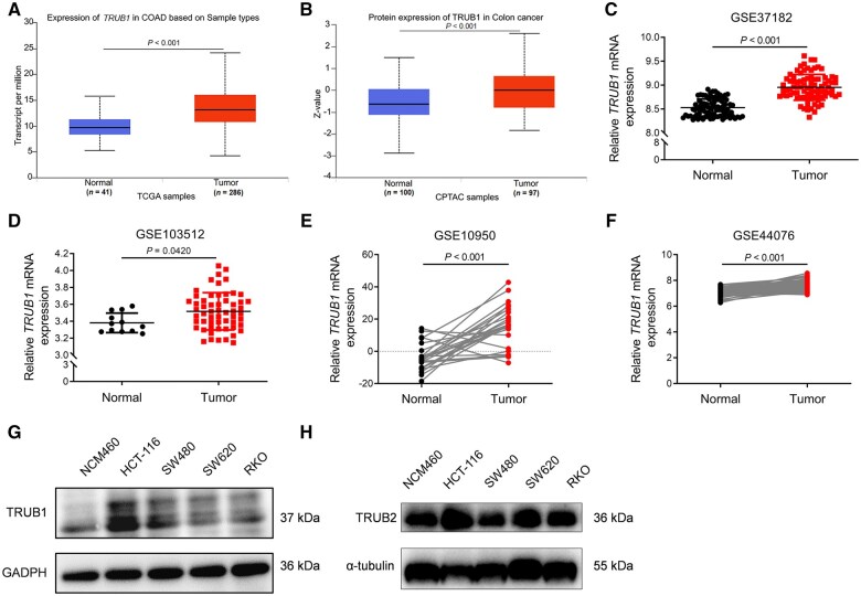 TRUB1 is a novel biomarker for promoting malignancy in colorectal cancer via NFκB signaling.