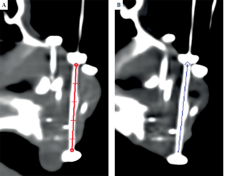 Quality control strategies for head and neck brachytherapy (interventional radiotherapy).