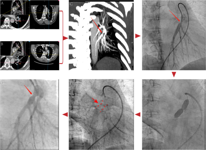 Pulmonary Artery Stent Implantation for Fibrosing Mediastinitis: Our Clinical Experience.