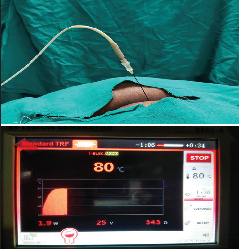 Comparison of radiofrequency thermocoagulation of ganglion Impar with block using a combination of local anaesthetic and steroid in chronic perineal pain.