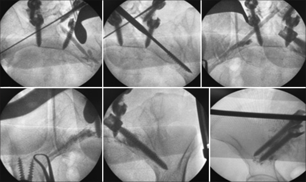 Polymethylmethacrylate augmentation of conventional pedicle screws in spine surgery - A modified classical method.