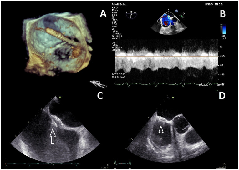Optimizing MitraClip Outcomes: The Case for Routine Iatrogenic ASD Closure.