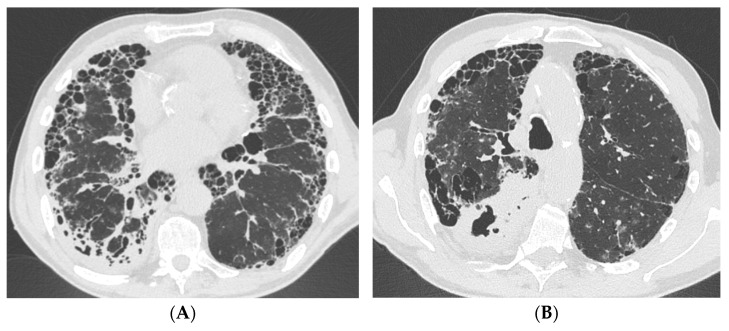 Usual Interstitial Pneumonia Pattern and Mycobacteria Lung Diseases: A Case Series.