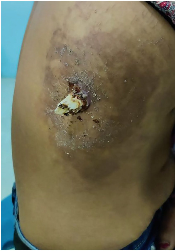 Chronic Rib Osteomyelitis in a Young Adult Female: Diagnostic Challenges and Implications of a Rare Case in a Resource-Limited Setting.