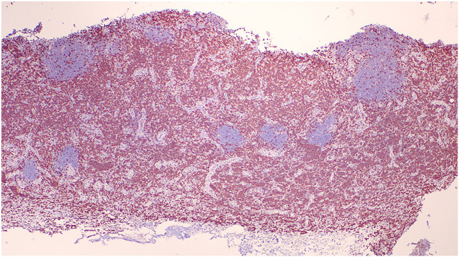 Clinicopathologic features and clinical outcome in a cat with nodal T-zone lymphoma.