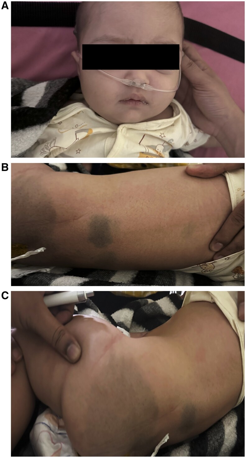 Imaging manifestations in infantile GM1 gangliosidosis: a rare lysosomal storage disorder: a paediatric case report.