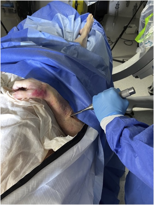 Video-Based Assessment of Surgical Skill in Orthopaedic Surgery: A Technique Guide to Capturing Critical Surgical Detail.