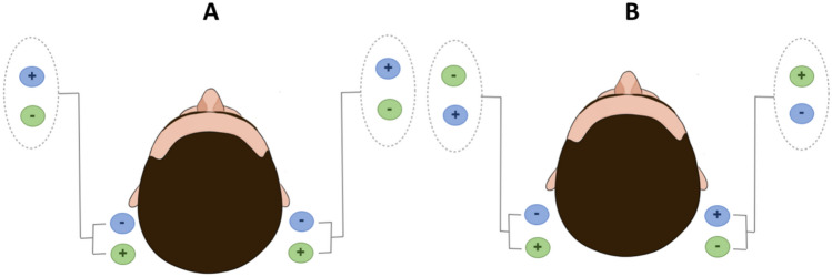 A wide-ranging review of galvanic vestibular stimulation: from its genesis to basic science and clinical applications.