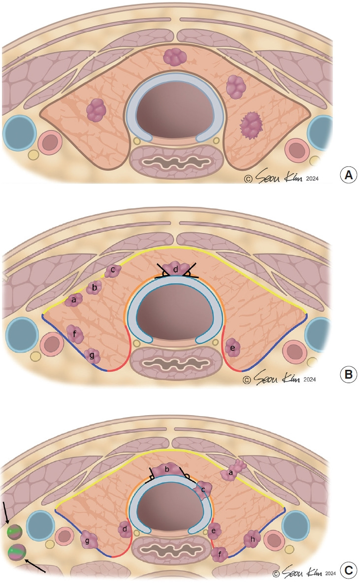 Ultrasound Imaging Criteria and Protocols for Active Surveillance of Low-Risk Thyroid Cancer: A Review of International Consensus Guidelines.