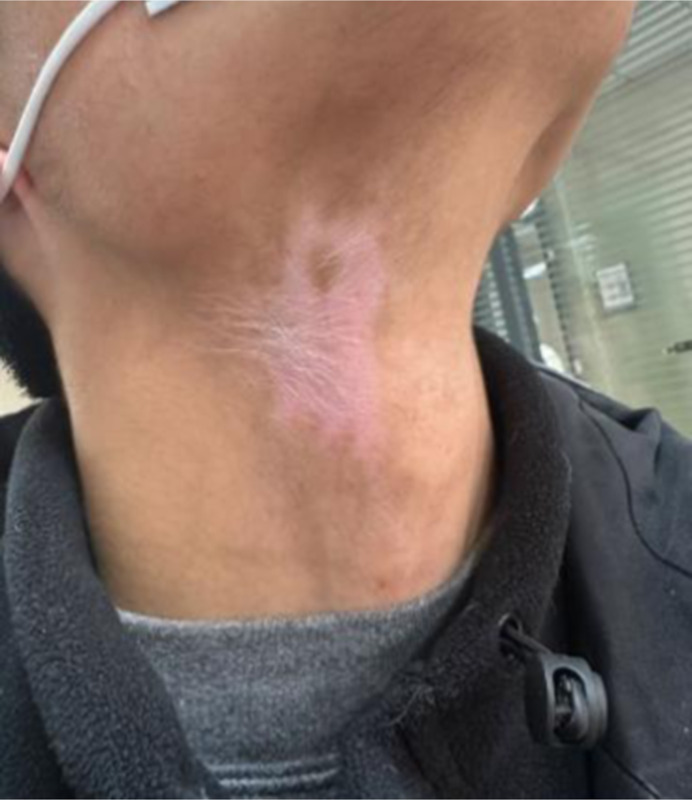 Focal Hypertrichosis during Topical Tacrolimus Therapy for Vitiligo: A Case Report.