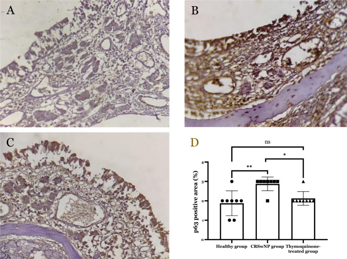 Therapeutic potential of thymoquinone in regulating p63, claudin, and periostin in chronic rhinosinusitis with nasal polyps: An animal model study.