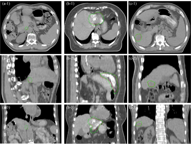 Dosimetric investigation of multi-parametric 4D-MRI for radiotherapy in liver cancer.