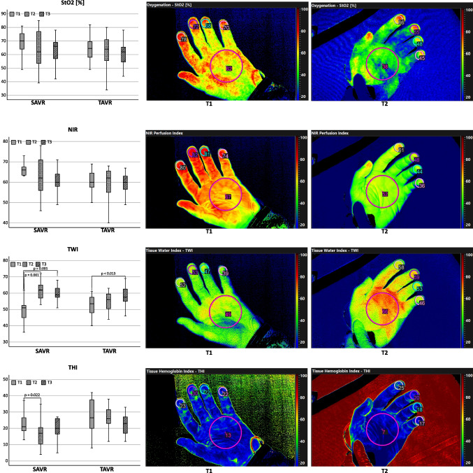 Hyperspectral Imaging for Microcirculatory Assessment of Patients undergoing Transcatheter and Surgical Aortic Valve Replacement-a Prospective Observational Pilot Study.