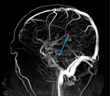 Exploring Central Venous Thrombosis as a Rare Postinfectious Complication of Dengue: A Case Report.