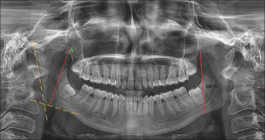 Prediction of gender from radiographic condylar and coronoid measurements using elastic net and random forests.