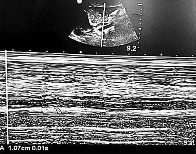 Interobserver reliability of sonographic measurement of inferior vena cava and aorta parameters in fasting children in the perioperative period: A prospective observational study.