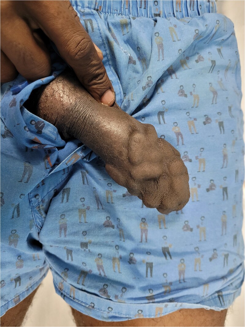 Methods, practices, and complications related to the use of artificial penile nodules within the French Guiana penitentiary.