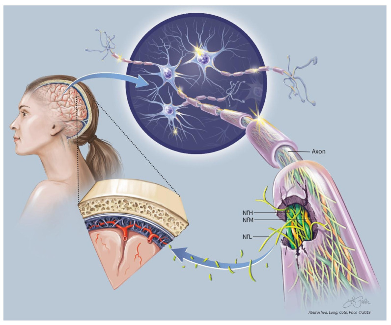 Neurofilament Light Chain and Multiple Sclerosis: Building a Neurofoundational Model of Biomarkers and Diagnosis.