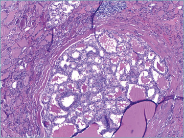 Evaluation of papillary thryoid carcinoma and its variants: multifocality in thyroid lobectomy and completion thyroidectomy - a single tertiary center retrospective study.