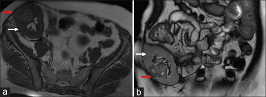 Partial nephrectomy for a completely endophytic tumor in an allograft kidney, 14 years after transplantation.