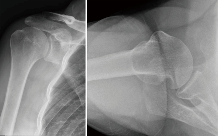 Management of anterior shoulder instability in the contact athlete: a narrative review.