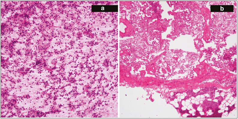 Intraoperative Decision-Making: A Comparative Analysis of Scrape Cytology vs. Frozen Section in Eighty Consecutive Samples.