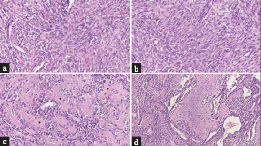 Pulmonary tumor with osteosarcomatous and chondrosarcomatous components: The differential diagnosis.