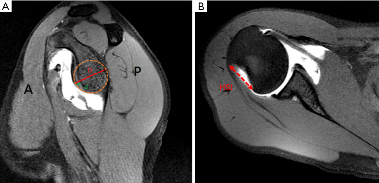 Management of anterior shoulder instability in the contact athlete: a narrative review.