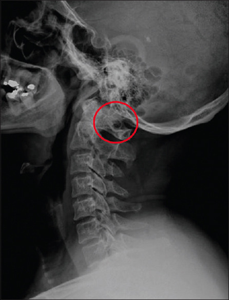 Exploring the prevalence and impact on craniocervical spine surgery of ponticulus posticus on atlas lamina thickness.