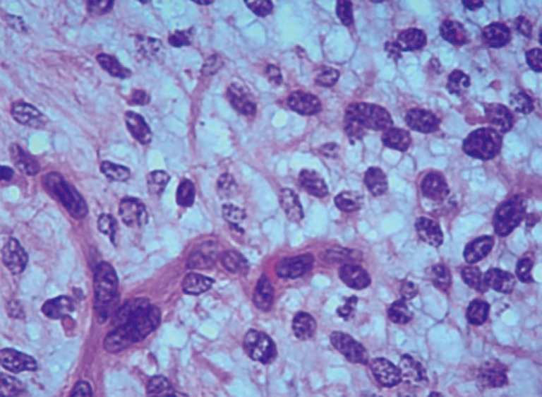 Robot-assisted partial gastrectomy with Billroth I anastomosis for gastric plexiform fibromyxoma in children: the first case report and literature review.