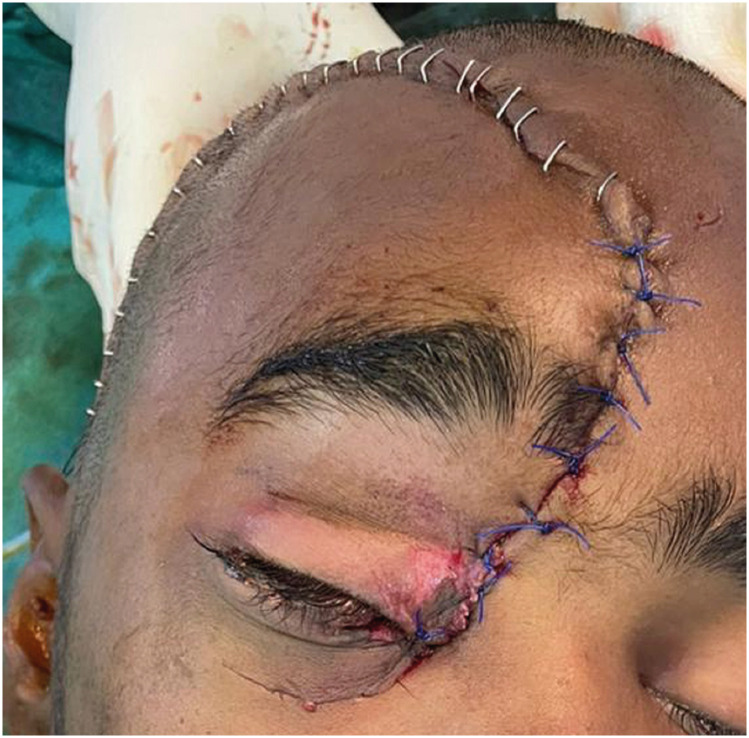 Agricultural Farm-Related Head Injuries in Rural India: A Case Series.