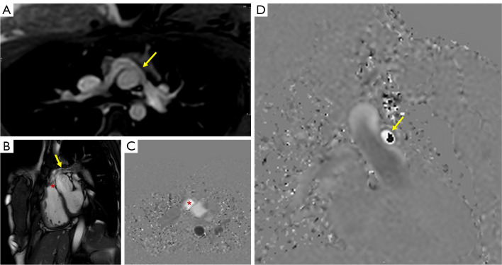 Cardiovascular magnetic resonance and valvular heart diseases: a suggested protocol for congenital lesions.