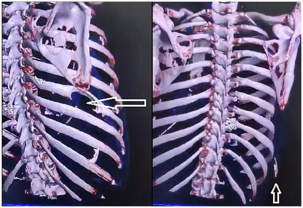 Chronic Rib Osteomyelitis in a Young Adult Female: Diagnostic Challenges and Implications of a Rare Case in a Resource-Limited Setting.