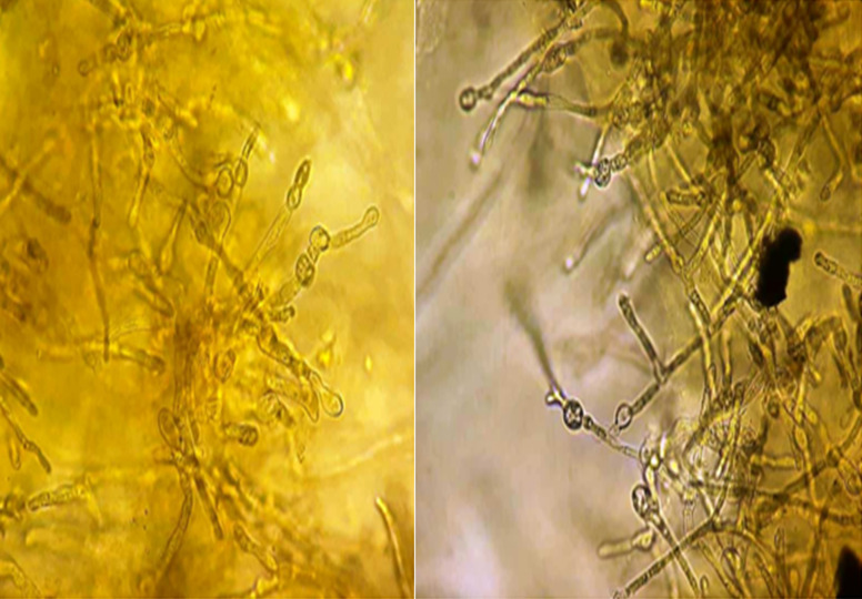<i>Epidermophyton floccosum</i>, an etiological agent of tinea pedis and tinea unguium: about two cases.