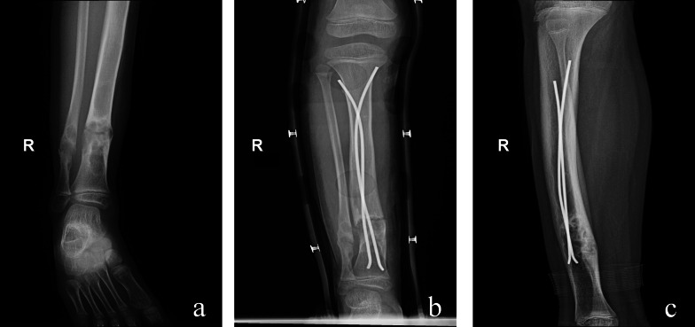 Feasibility of non-radical resection combined with internal fixation for adolescents with lower limb fibrous dysplasia: a single-center retrospective study with a small sample size.