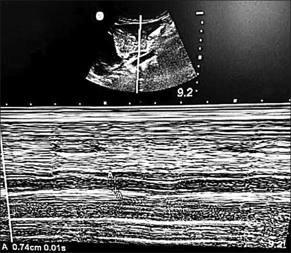 Interobserver reliability of sonographic measurement of inferior vena cava and aorta parameters in fasting children in the perioperative period: A prospective observational study.
