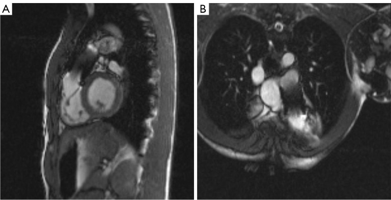 Cardiovascular magnetic resonance and valvular heart diseases: a suggested protocol for congenital lesions.