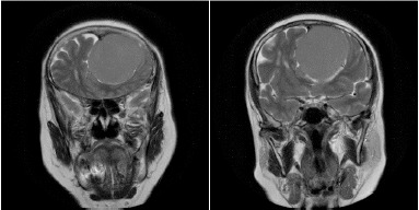 Foster Kennedy Syndrome from Frontal Lobe Meningioma: A Rare Case Report.