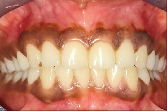 Vitamin C as a probable inhibitor of tyrosinase (Tyr) and tyrosinase-related protein-1 (TRP-1) in human gingiva: An analytical study.