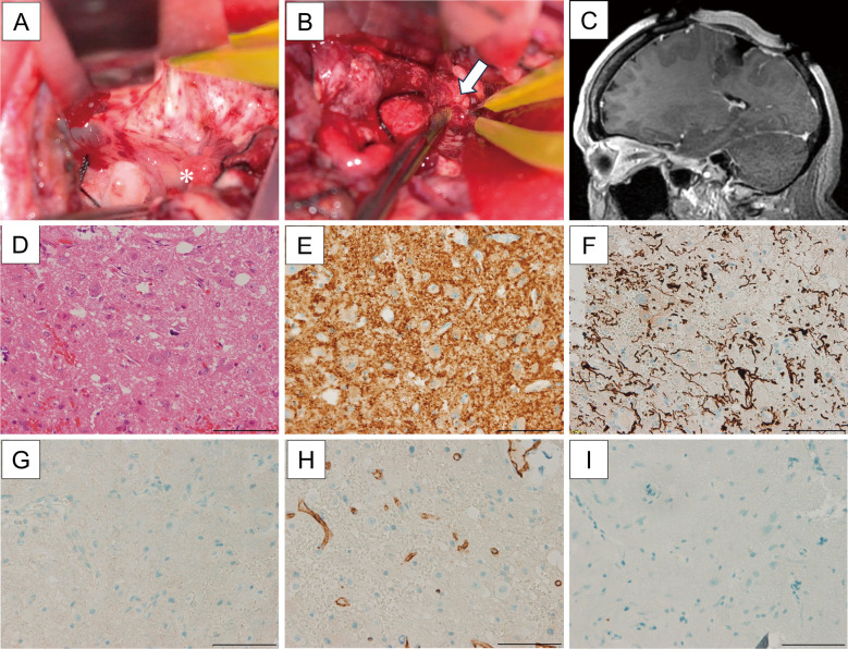 A Rare Case of Adult-onset Gangliocytoma in the Parietal Lobe: Case Report and Surveillance, Epidemiology, and End Results Registry Data Analysis.