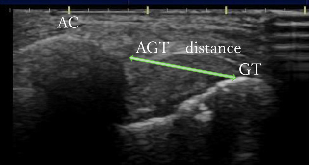 Reliability and utility of ultrasound imaging assessment methods for shoulder subluxation in patients with stroke.