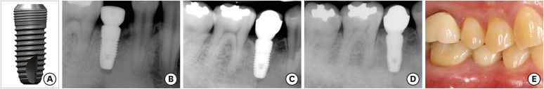 Long-term clinical and radiographic outcomes of a bone-level, 2-piece, internal connection implant system with coronal microthreads over 10 years of follow-up: a retrospective clinical study.